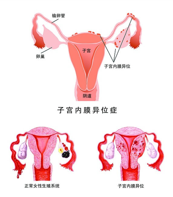 三代试管,试管婴儿
