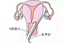 试管婴儿卵泡多大可以取卵 取卵后要注意什么