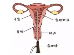 宫腔粘连能直接做试管婴儿吗