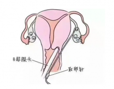试管婴儿取卵子疼不疼？才做流程是怎么样的？
