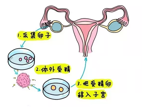 俄罗斯试管婴儿
