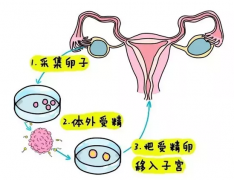 试管婴儿取卵后是不是马上培育