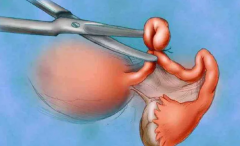 输卵管堵塞通过哪种方法治疗效果最好见效最快？