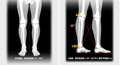 试管婴儿能规避 O 型腿遗传吗？